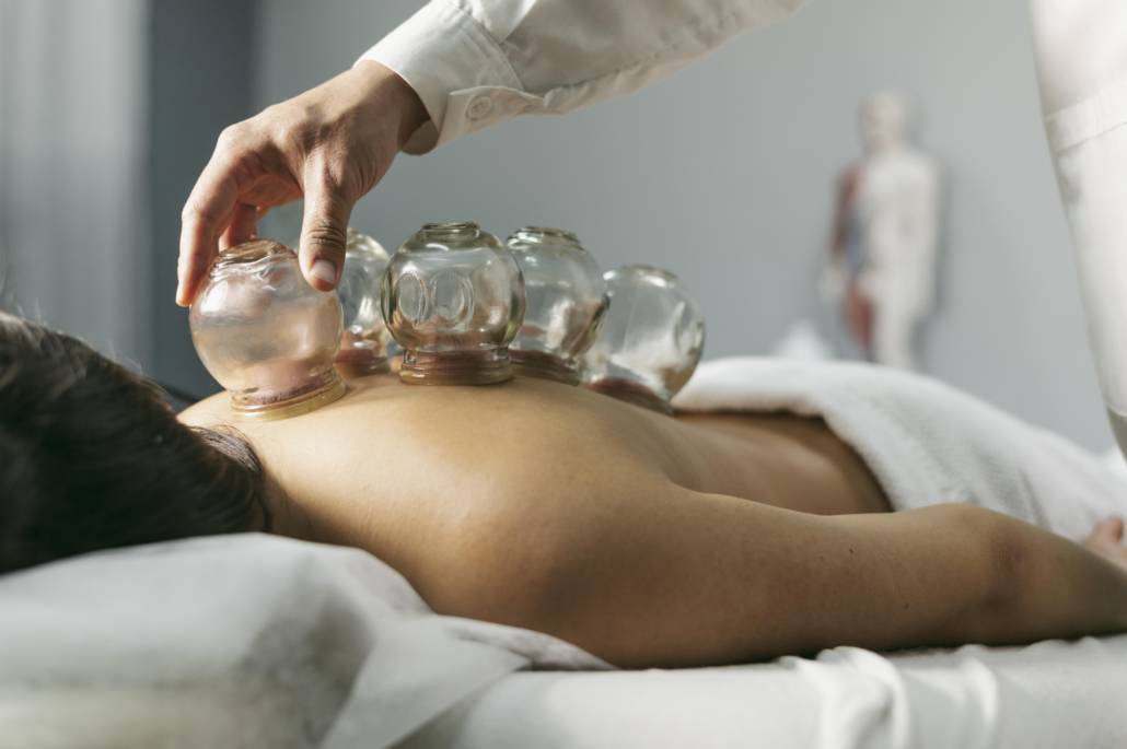 cupping therapy